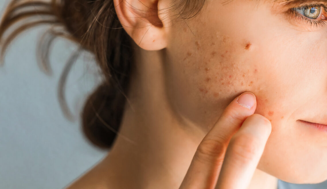How Women With Hormonal Acne Can Feel Confident